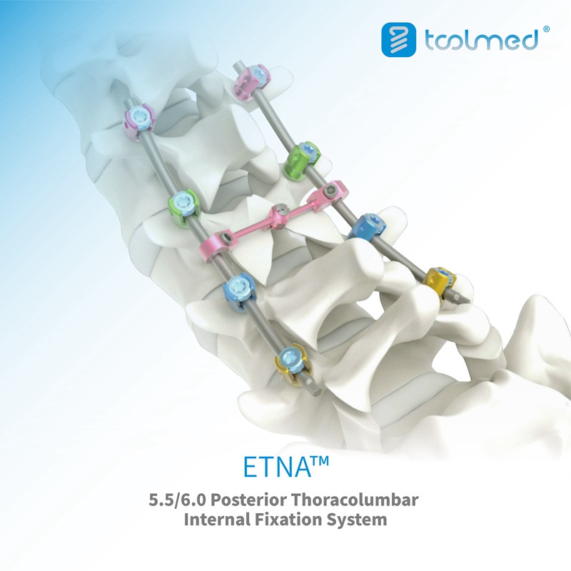 ETNA 5.5 & 6.0 Posterior Thoracolumbar Internal Fixation System