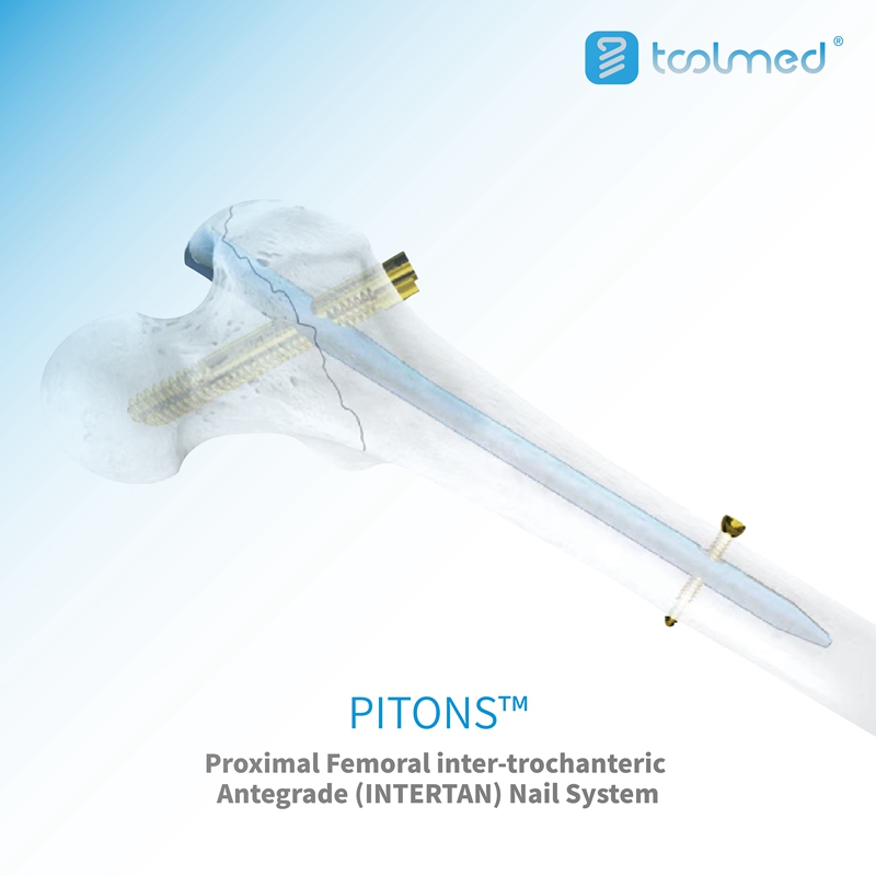 PITONS™ Intertan Intramedullary Nail System